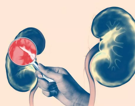 Ilustrace ledvin s lupou ukazující zánět u selhání ledvin