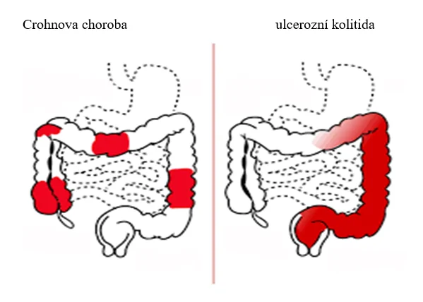 Porovnání Crohnovy choroby a ulcerozní kolitidy v tlustém střevě