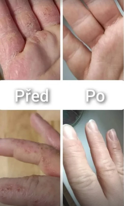 Porovnání rukou před a po léčbě dyshidrotického ekzému