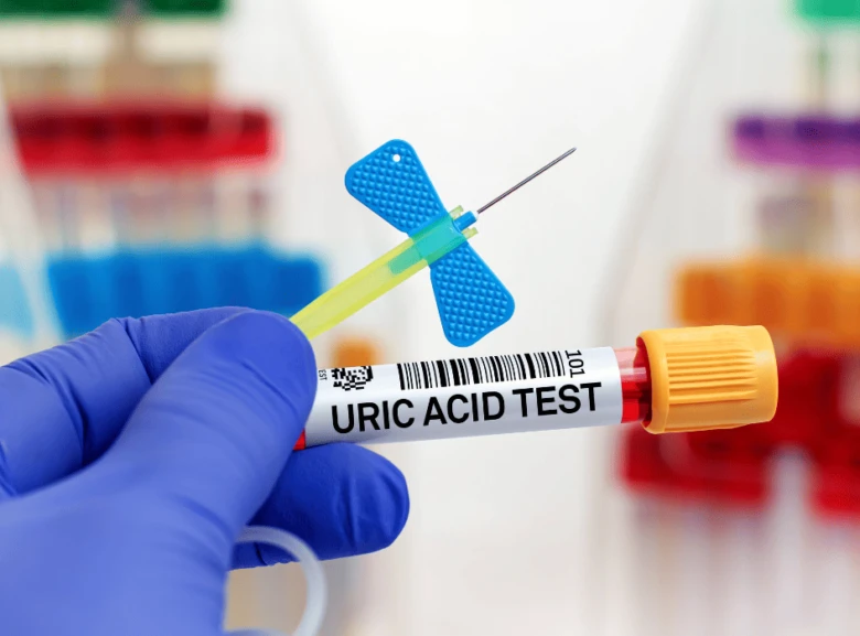 Test na kyselinu močovou v laboratoři