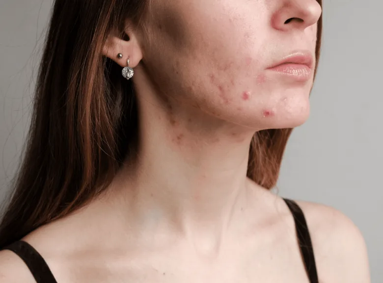 Žena s akně na krku a tváři