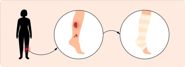 Ilustrace léčby vředů na lýtku elastickým obvazem.
