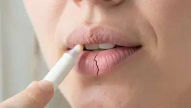 Jak léčit prasklý koutek na rtu - ilustrační foto