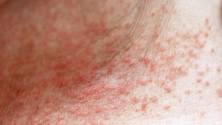 Child's skin rash