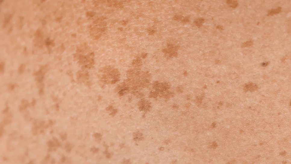 Skin with freckles