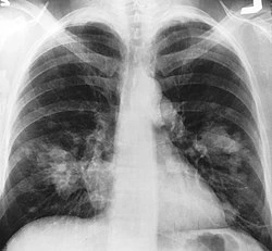 Chest x-ray image