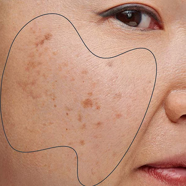 Pigmented skin spots on face