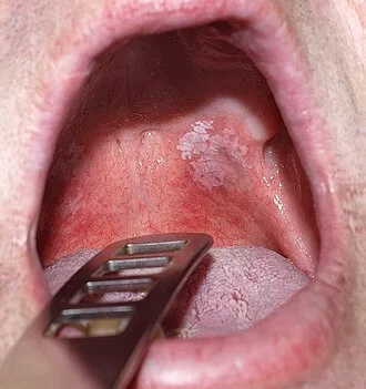 Bílá skvrna na sliznici úst dutiny při leukoplakii.