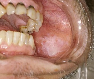 Bílá skvrna na sliznici úst jako příznak leukoplakie.